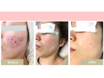 長寿鍼灸院 長寿整骨院/フォト美顔の効果★