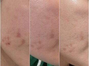 グッドスリープ(Good sleep)/KMP 韓国式ハーブピーリング