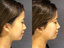 ユウキシキ(YUKISIKI)/YUKISIKI小顔矯正&美容鍼