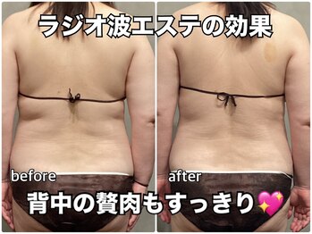 リエル(RIEL)/ラジオ波エステ