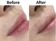 モンロー(MonroE+)/脱毛