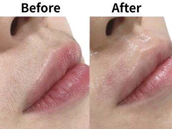 モンロー(MonroE+)/脱毛