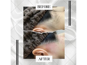 バロックビューティーラウンジ(BAROQ beauty lounge)/最新光脱毛
