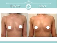 美人バスト 新潟店/ 【バストアップ★育乳】症例