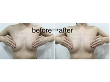 トータルビューティーサロン ナーズ(NAZ)/光バストアップ