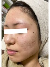 ノーブル 新宿南口(NOBLE)/新宿ハーブピーリングNOBLE