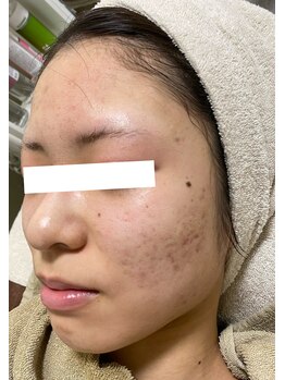 ノーブル 新宿南口(NOBLE)/新宿ハーブピーリングNOBLE