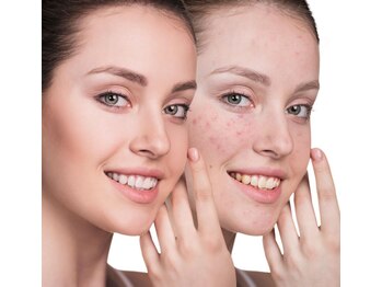 ゴールドハンド 溝の口店(Gold Hand)/ニキビ肌ケア最新光アイス導入