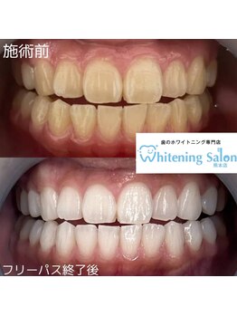ホワイトニングサロン 熊本店/安いセルフホワイトニング