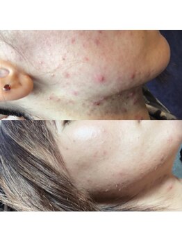 ヴィヴィ(ViVi)/【効果実感！】話題のHAABリプロ