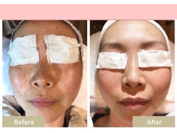 長寿鍼灸院 長寿整骨院/フォト美顔の効果★