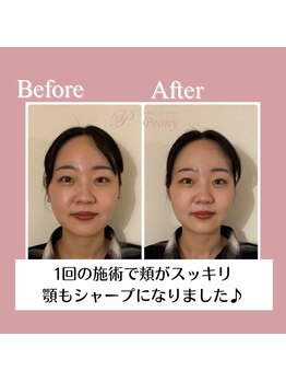 ピオニー(Peony)/Before & After