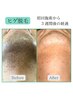 【まずはお手軽に鼻下から効果を実感!】 ヒゲ脱毛（鼻下）通常¥4000→¥1000