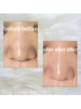 アールビューティーサロン(R Beauty Salon)/ハーブピーリング/before after