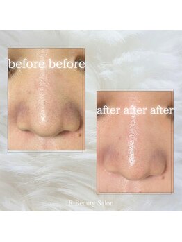 アールビューティーサロン(R Beauty Salon)/ハーブピーリング/before after