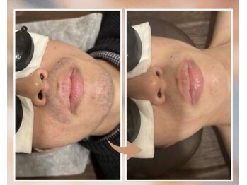 プルベル 平尾(Plus Belle)/ヒゲ脱毛