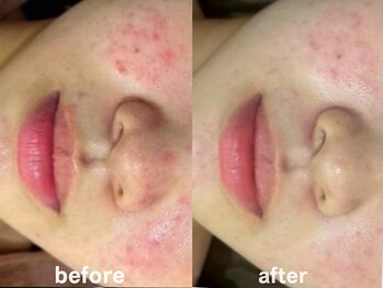 ホワイトアクア 鹿児島店(WHITE AQUA)/ハーブピーリング3ヶ月/肌質改善