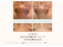 #毛穴の自己流ケアに困ったらシーズへ♪