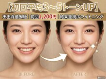 ココホワイトニング 天王寺店