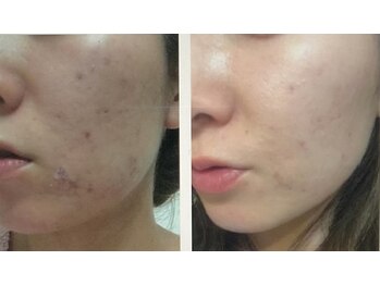 ブルームオーラ 月(BLOOM AURA)/IPSで叶える。憧れの陶器肌へ。