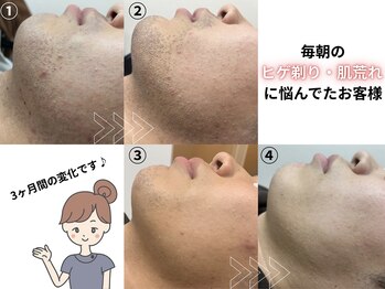 ジェントル 福岡天神店(GENTLE)の写真/【第一印象が変わるヒゲ脱毛】青&濃ヒゲを改善♪朝の忙しい時間に髭剃りがめんどくさい!荒れるという方へ