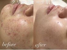 シーラックス(Sealax)の雰囲気（大人のニキビ、毛穴悩みも多くご相談いただいております）
