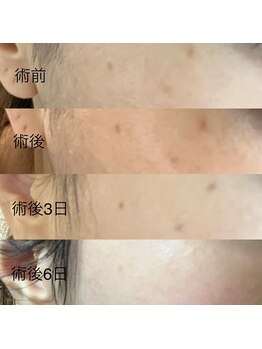 パシテア(Pasithea)/シミ改善ケア