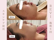 ルア(LuA.)/敏感肌も改善♪