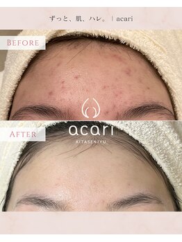 アカリ(acari)/頑固な額ニキビ