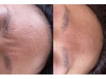 れふぇるん 足利店/30代 毛穴&シワ改善 施術1回