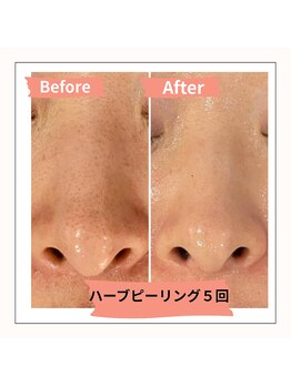 ニゲラ(Nigella)/ハーブピーリング