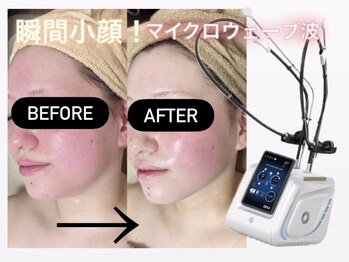 アテ(Ate)の写真/韓国最新『マイクロウェーブリフト』最強瞬時に小顔！たるみ、くっきりフェイスライン、口横ぽにょ肉に◎