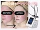 アテ(Ate)の写真/韓国最新『マイクロウェーブリフト』最強瞬時に小顔！たるみ、くっきりフェイスライン、口横ぽにょ肉に◎