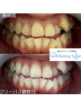 ホワイトニングサロン 熊本店/男性もOKセルフホワイトニング