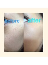 毛穴専科/シミケア導入キャンペーン中！！