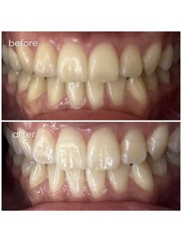 エクシアホワイトニング 津駅前店/お客様ビフォーアフター