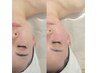 【小顔】３D造美顔×ラジオ波フェイシャル80分12000→7,200【痩身マシン☆】