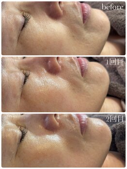 トレア(TREA)/ラミネーションピール