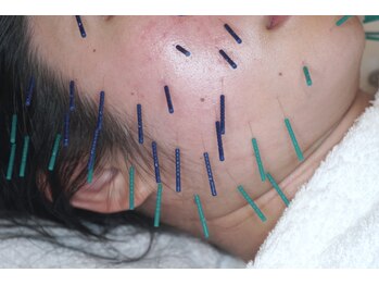 岩川治療院/細かに筋肉を捉えて刺鍼