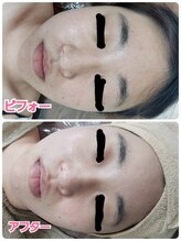 メヴィ(mavie)/カーボキシー炭酸パック（1）