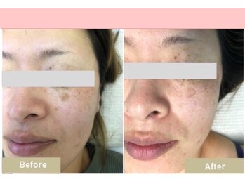 長寿鍼灸院 長寿整骨院/フォト美顔の効果★