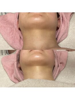 リリー(Lily)/小顔ゼロコルギ