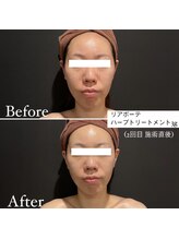 ミエル 神戸店(Miel)/リアボーテハーブトリートメント