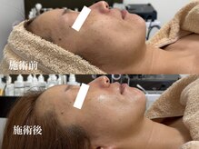 キーオブフェイス(Key of Face)/お悩み【顔がたるんできた】