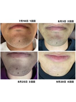 ビューティークリニックコダマ 都城店/メンズも増えてます!