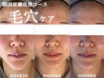 アールエーサロン 恵比寿 広尾(Ra salon)/韓国皮膚改善コース毛穴ケア