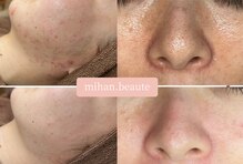 ミハン ボーテ(mihan.beaute)