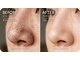 スターラッシュ(Star Lash)の写真/ 毛穴汚れごっそり！【韓国式♪3D毛穴洗浄体験★2980円】黒ずみ・角栓を浮かせて吸引♪圧倒的な変化◎
