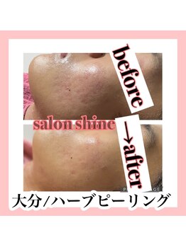 サロンシャイン(Salon Shine)/ハーブピーリング７日間
