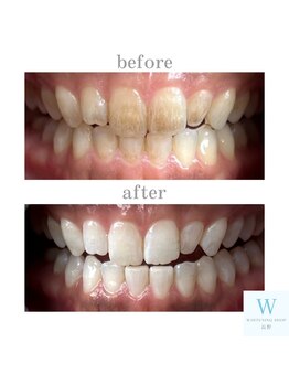 ホワイトニングショップ 長野店/タバコのヤニも綺麗に♪